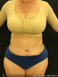 Tummy Tuck