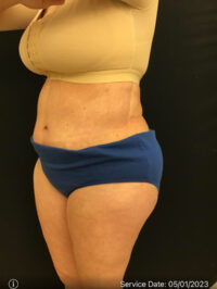 Tummy Tuck