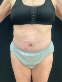 Tummy Tuck