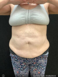 Tummy Tuck