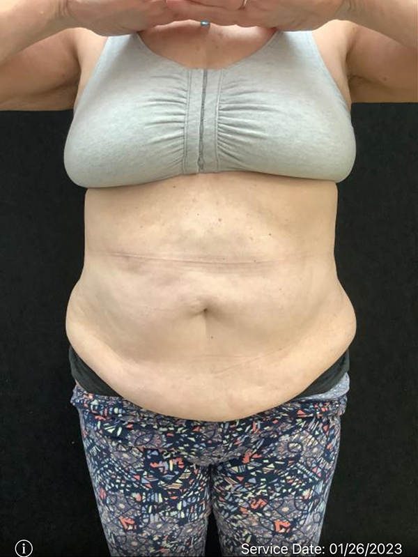 Tummy Tuck