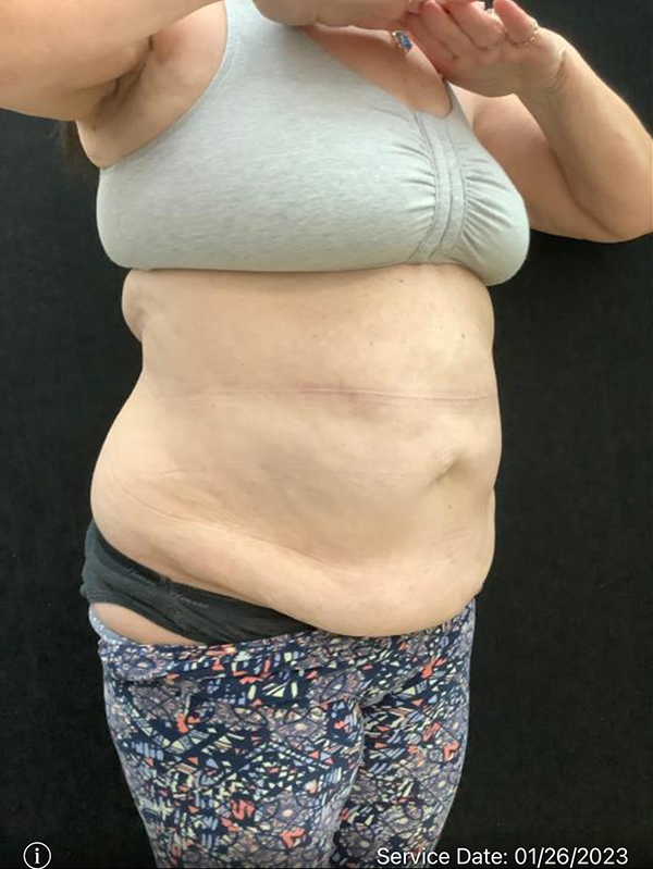 Tummy Tuck