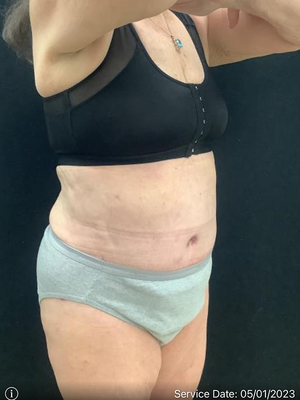 Tummy Tuck