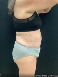 Tummy Tuck