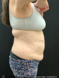 Tummy Tuck