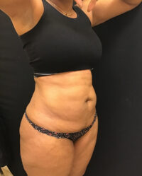 Tummy Tuck