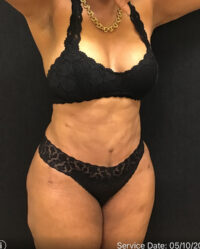 Tummy Tuck