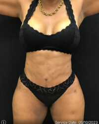 Tummy Tuck