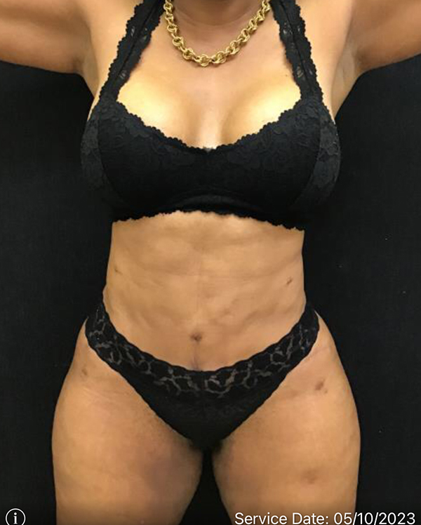 Tummy Tuck