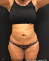 Tummy Tuck