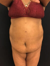 Tummy Tuck