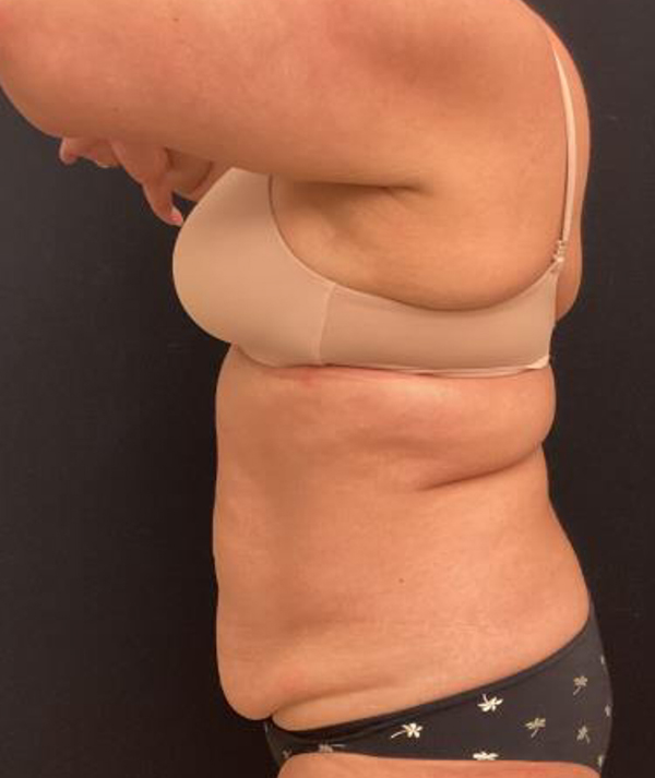 Tummy Tuck