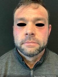Around The Eye Fillers