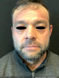 Around The Eye Fillers
