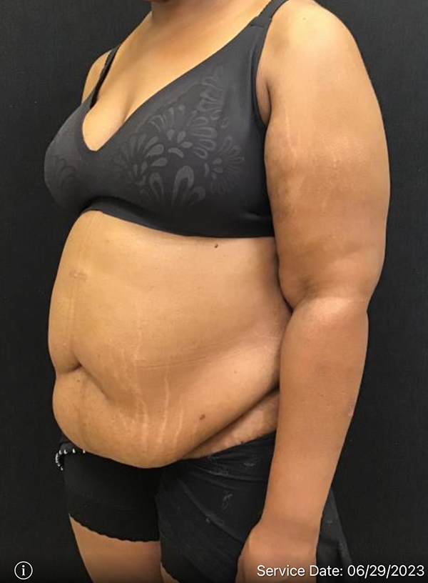 Tummy Tuck