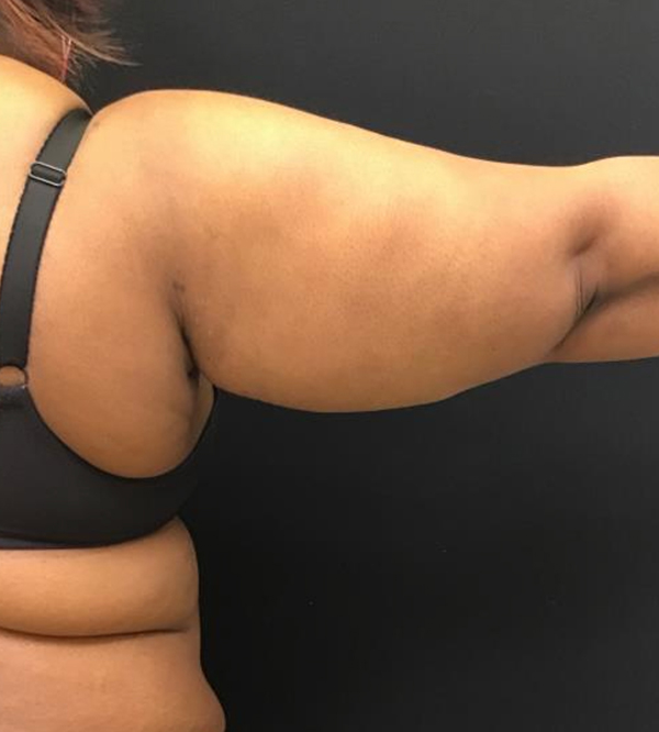 Tummy Tuck