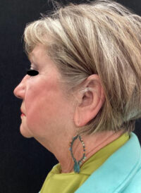 Facelift