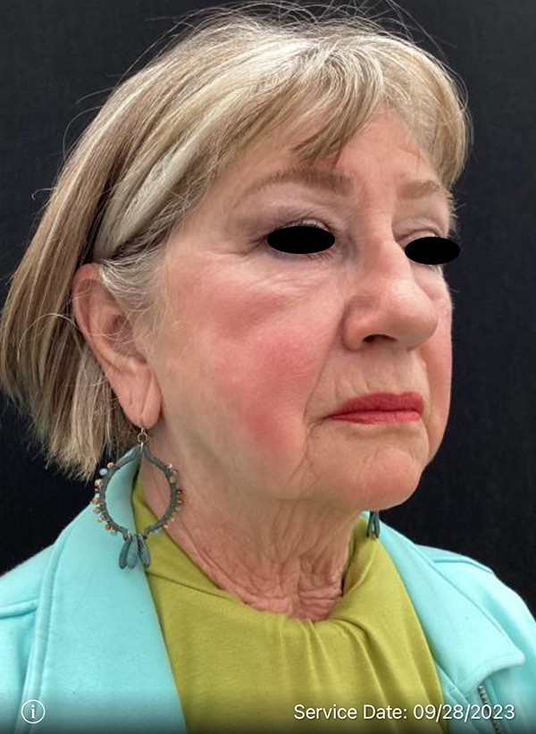 Facelift