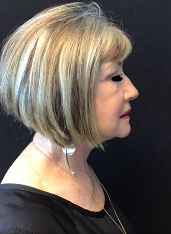 Facelift