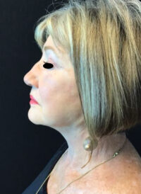 Facelift