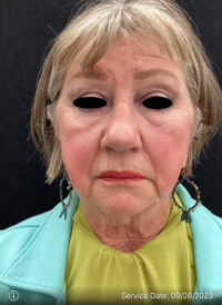 Facelift
