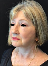 Facelift