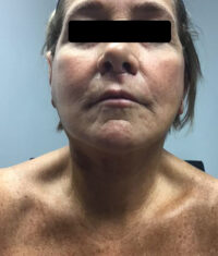Facelift