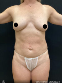 Breast Augmentation