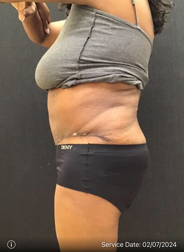 Tummy Tuck