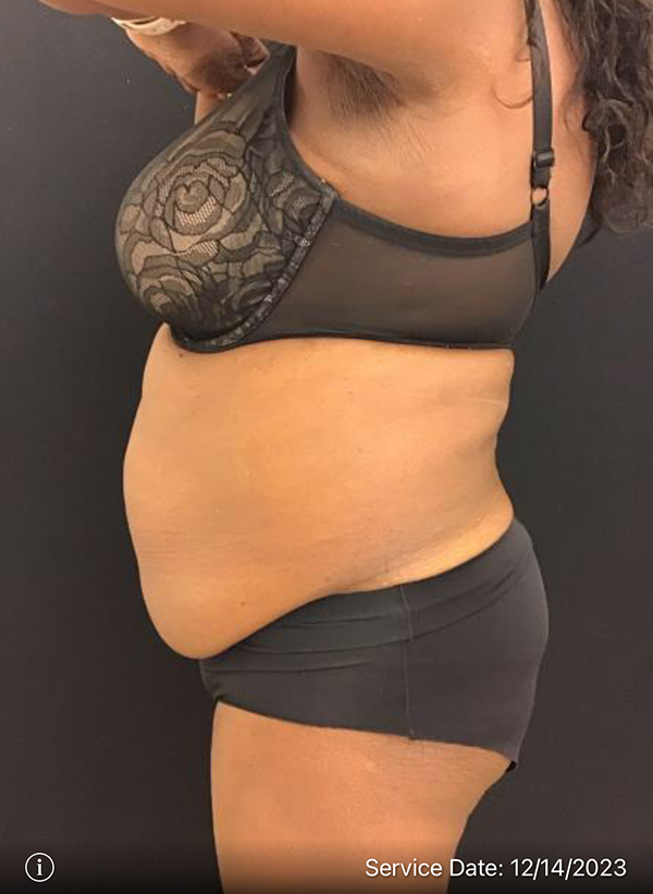 Tummy Tuck