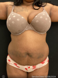 Liposuction