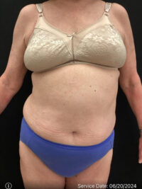 Liposuction