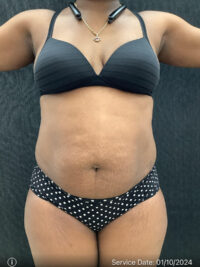 Liposuction