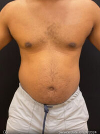 Liposuction