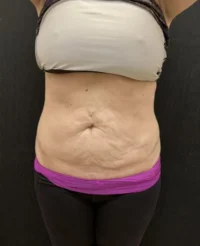 BodyTite