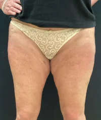 BodyTite