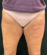 BodyTite