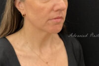 Facetite