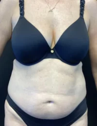 BodyTite