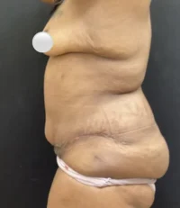 Tummy Tuck