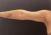 BodyTite