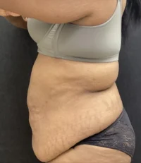 Tummy Tuck