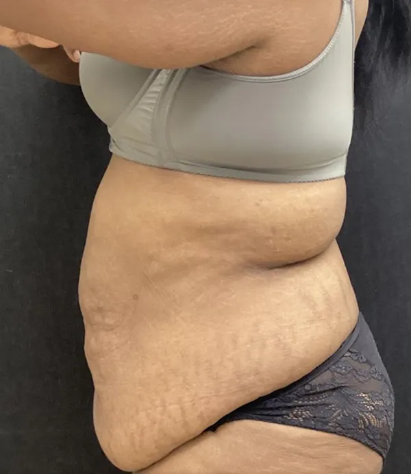 Tummy Tuck