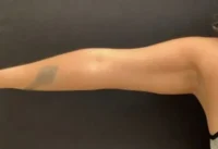 BodyTite
