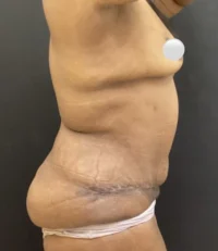Tummy Tuck