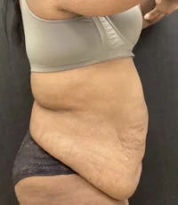 Tummy Tuck