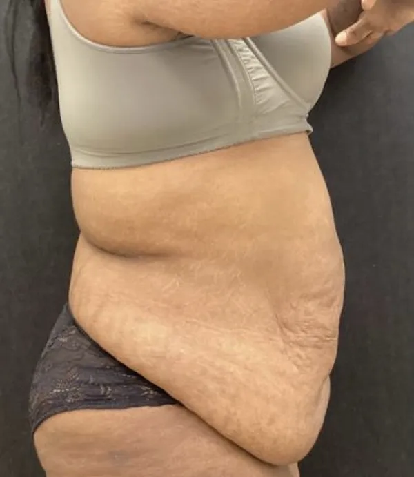 Tummy Tuck