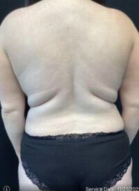 BodyTite