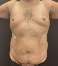 Tummy Tuck