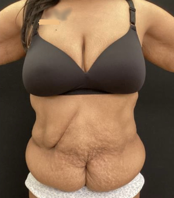 Tummy Tuck